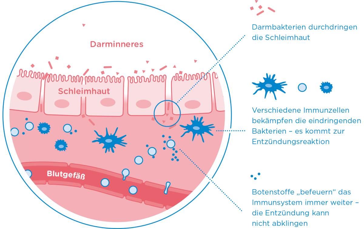 T-Zellen-Therapie bei Colitis ulcerosa