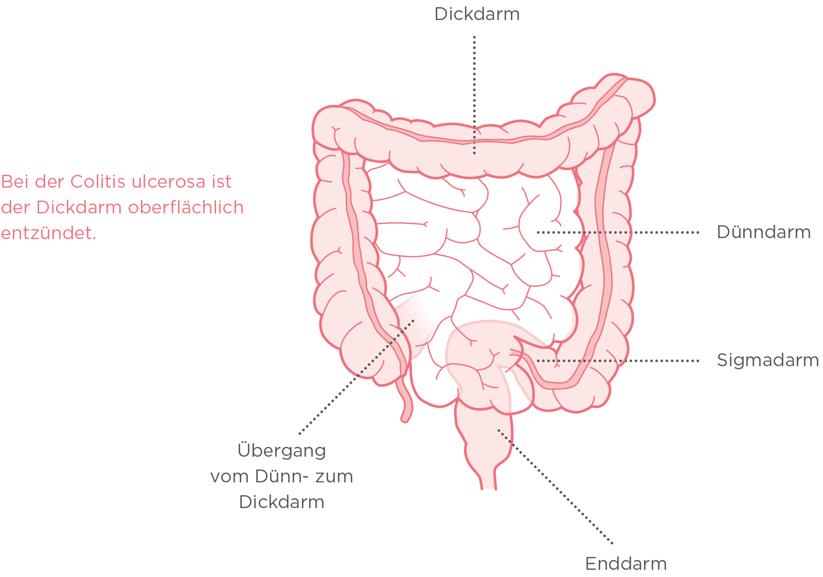 Tratamientos para colitis ulcerosa