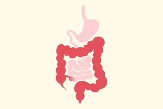 Colitis ulcerosa