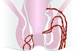 Perianale Fisteln bei Morbus Crohn