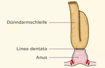 Schwerer Colitis-ulcerosa-Verlauf: Schema eines J-Pouch 