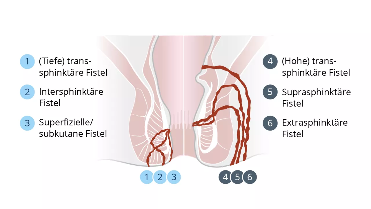 Arten von perianalen Fisteln 
