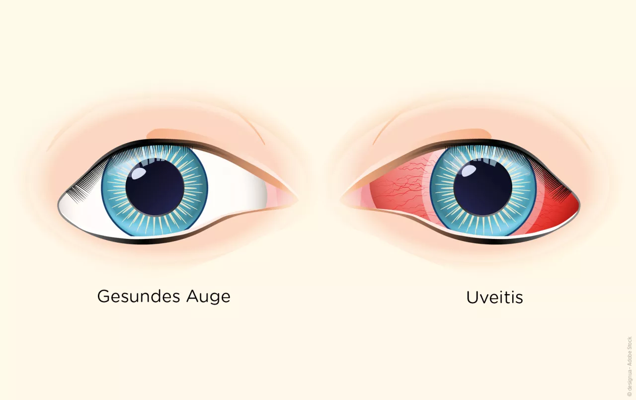 Uveitis bei CED 