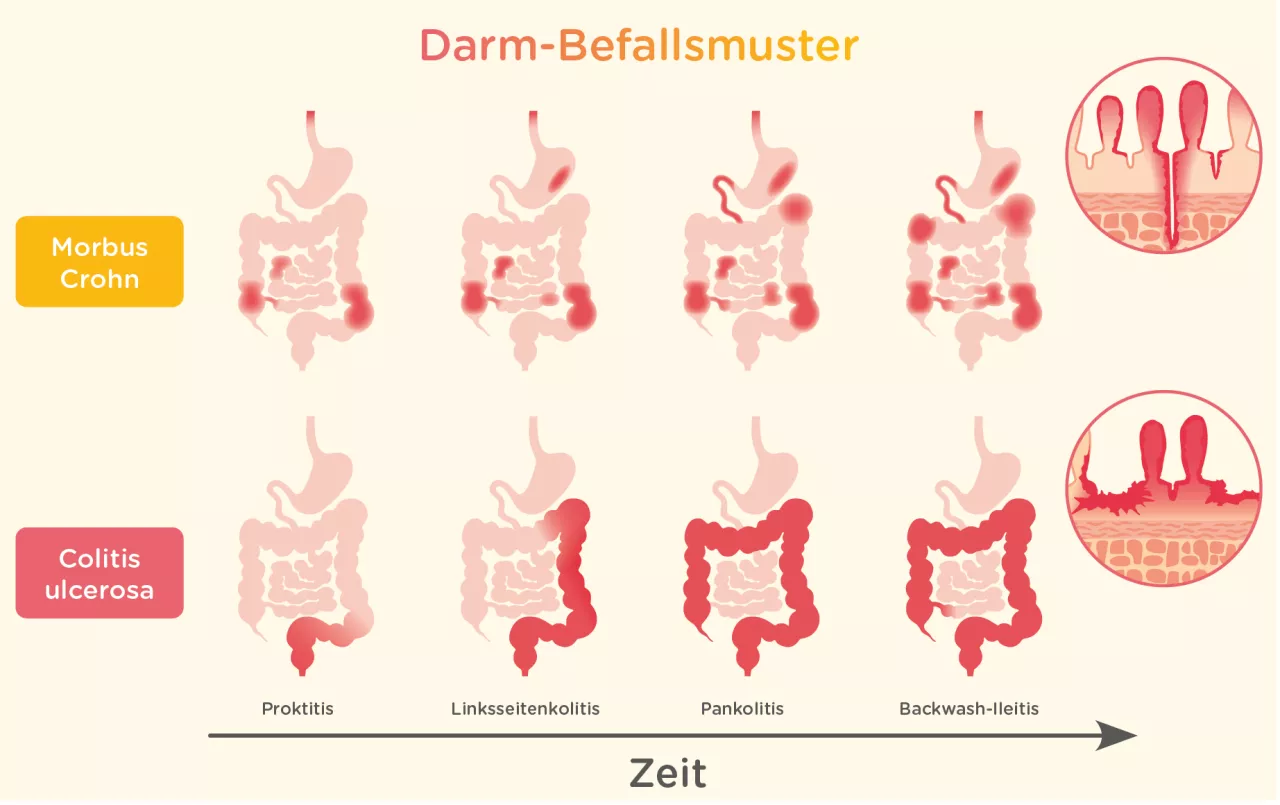 Darm-Befallsmuster Morbus Crohn Colitis Ulcerosa