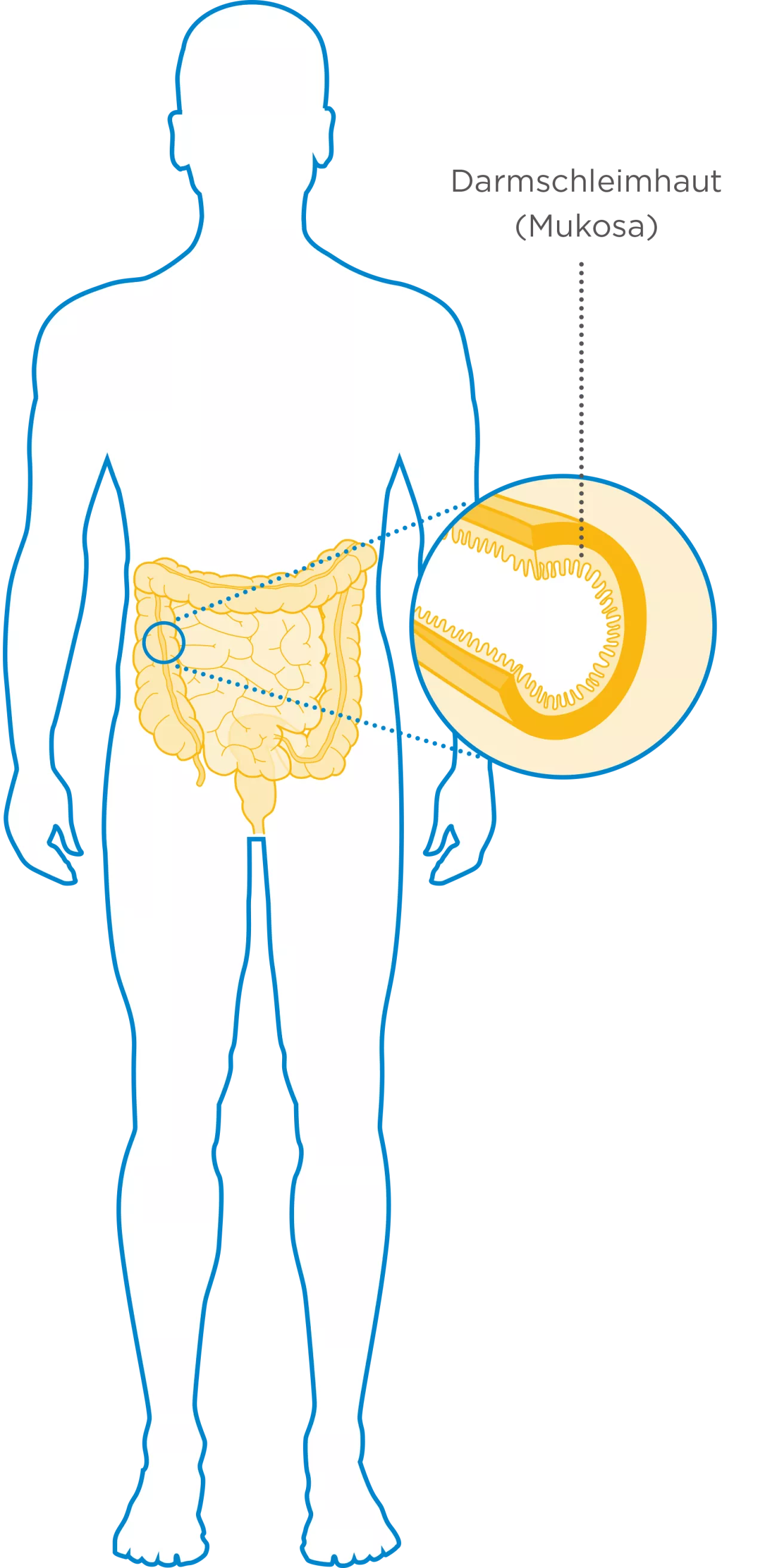 Morbus Crohn - Was passiert Silhouette