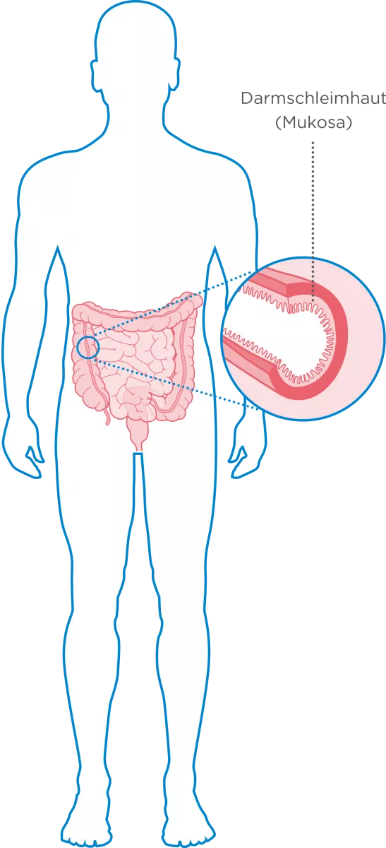 Colitis ulcerosa was passiert Silhouette